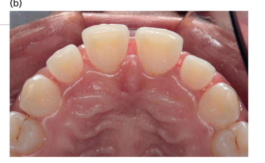 (b) Complete resolution after 60 days.