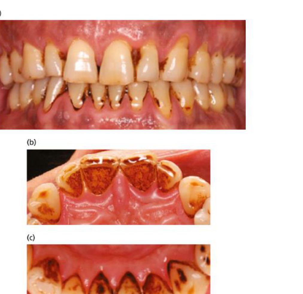 Fig. 11-8 Clinical appearance of a 53-year-old male patient who reports smoking one pack a day for 35 years. (a) Anterior view; (b) palatal view of the maxillary anterior teeth, and (c) lingual view of the mandibular anterior teeth. Note the heavy staining. Periodontal examination revealed probing depths of up to 9 mm, gingival recessions, and furcation involvements at all molars. Source: Courtesy of Dr. Matthew Hickin.
