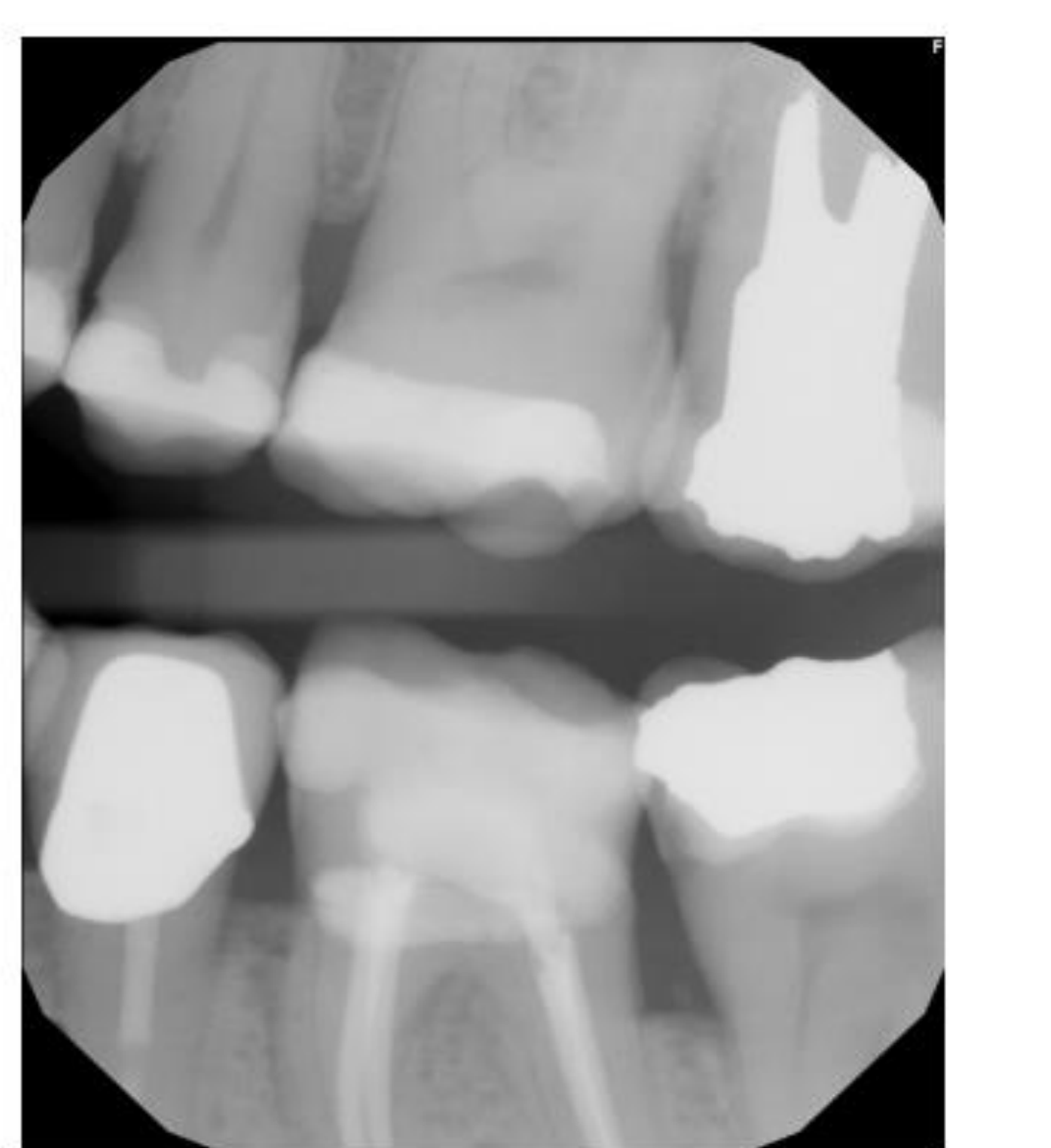 Fig. 12. Stage 2 Periodontal Disease (mandibular + maxillary left posterior) bitewing radiograph: Radiographic bone loss limited to the coronal third (15%-33%). Image provided by authors.