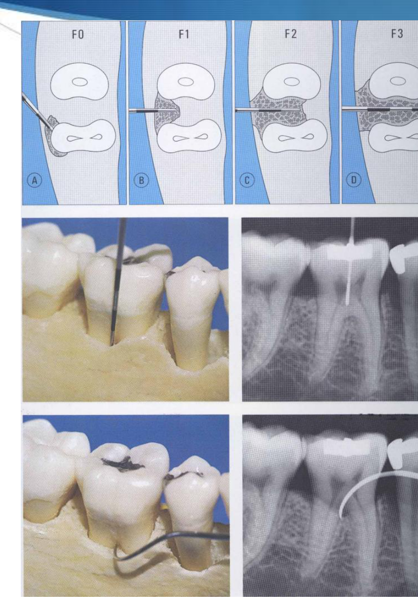 Diagnosis & Classification of furcation involvement