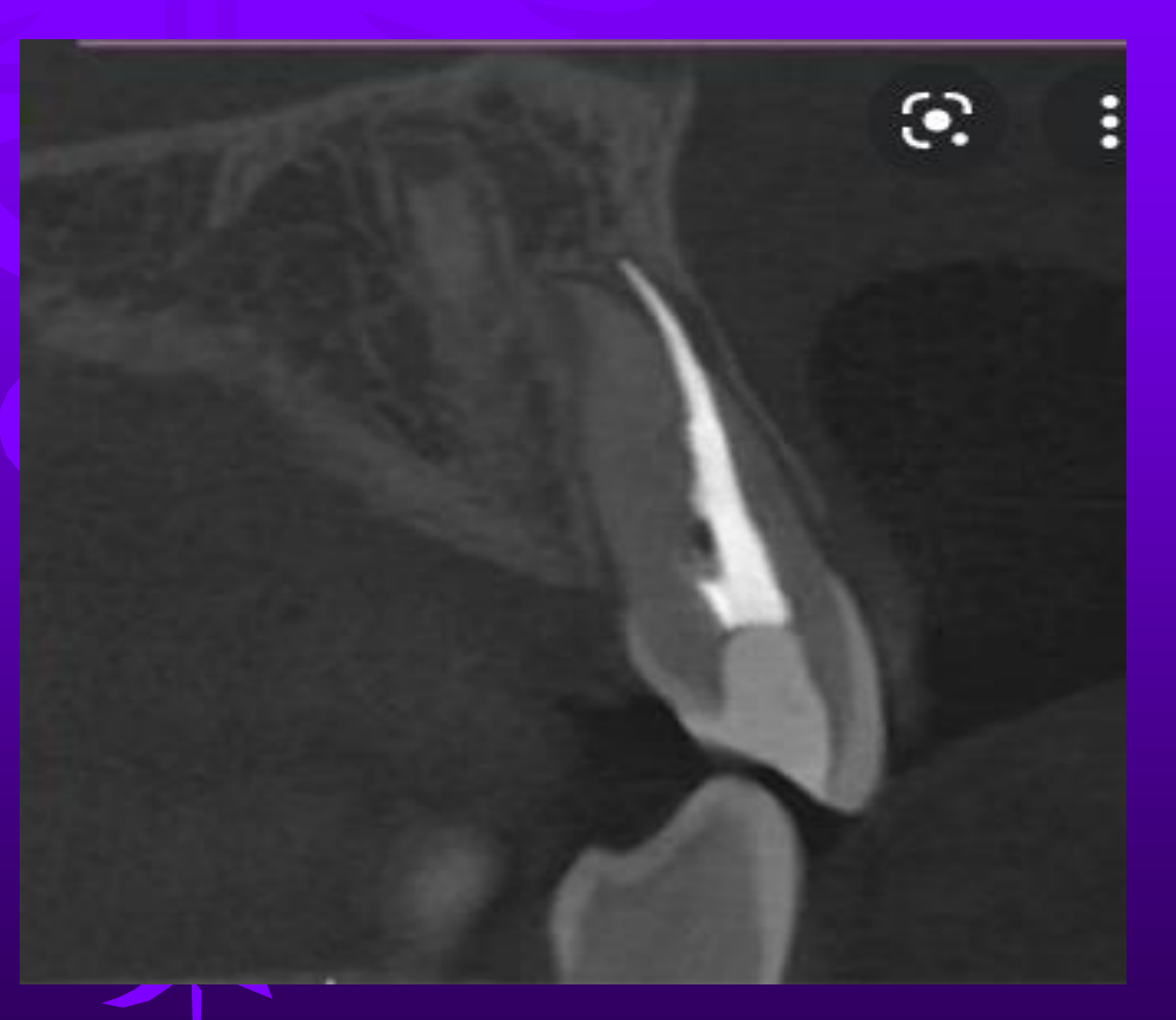 Or a root perforation?