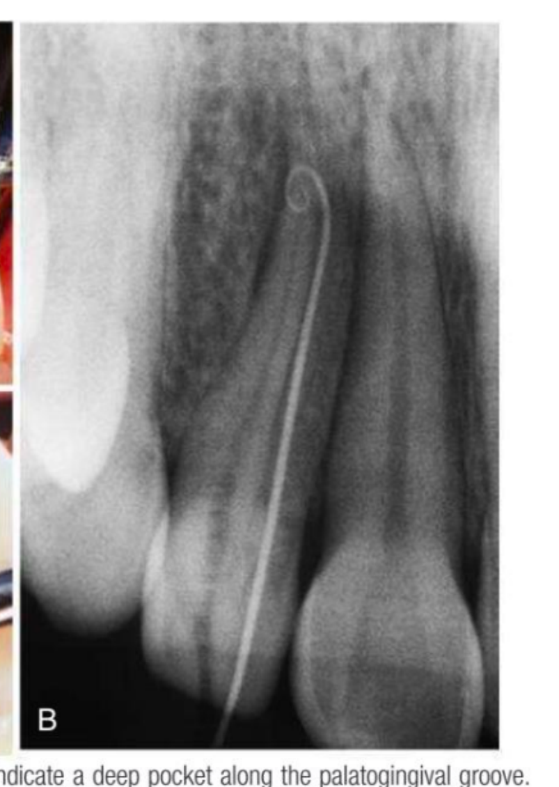 (B) Radiograph with a gutta-percha point placed in the pocket.