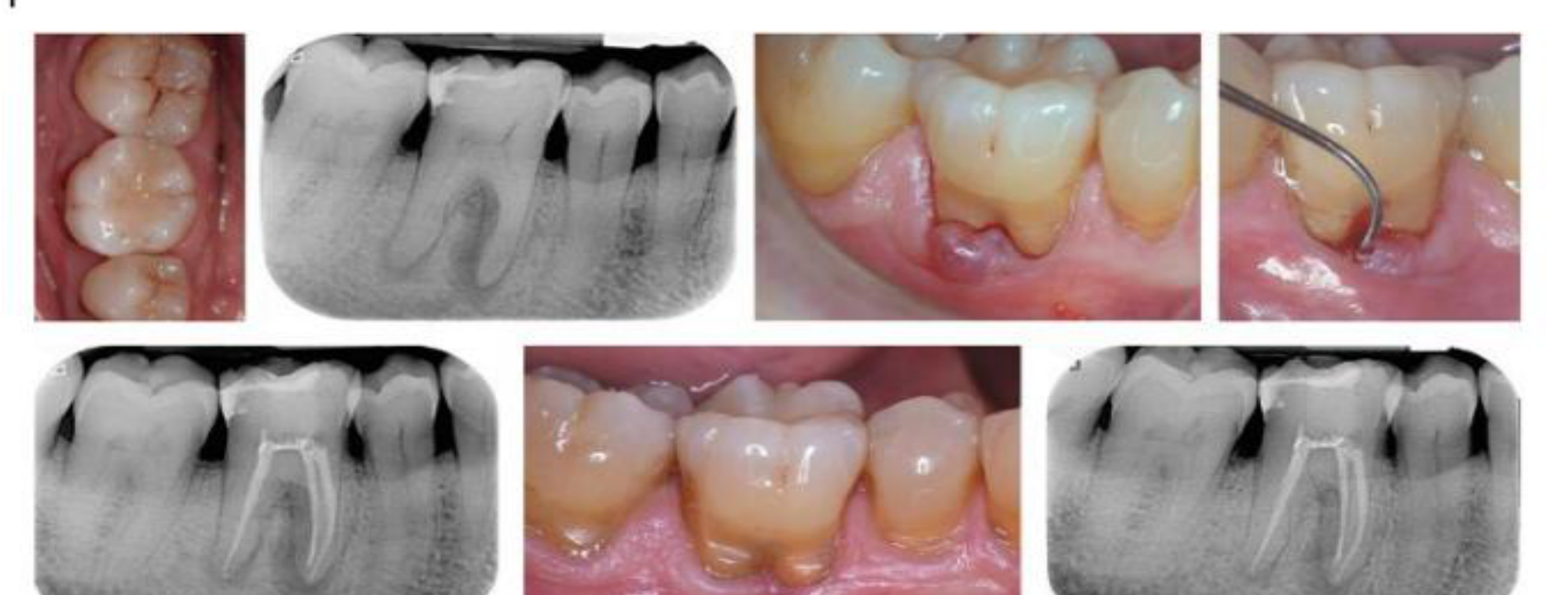 Figure 4.7 Primary endodontic lesion with inter-radicular and apical involvement on 4.6 (LR6). No furcation probing after three months and partial healing after one-year follow-up.