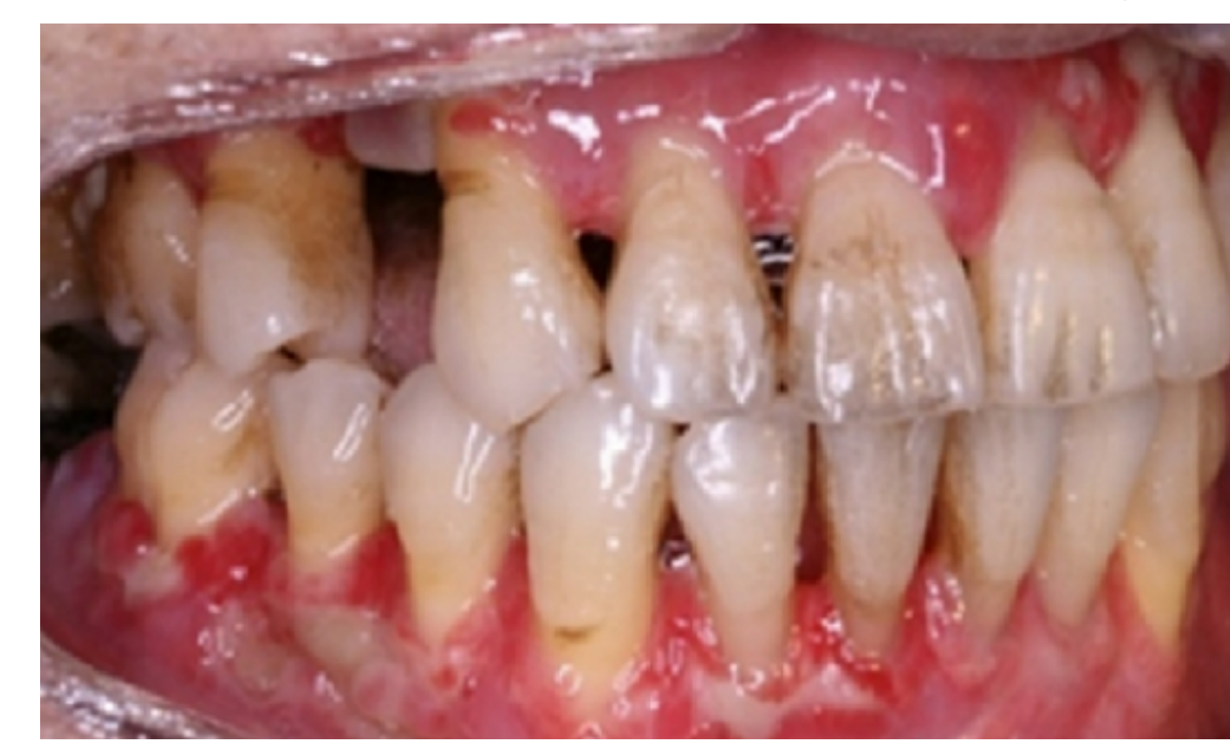 Acute Candida infection in a cancer patient receiving chemotherapy
