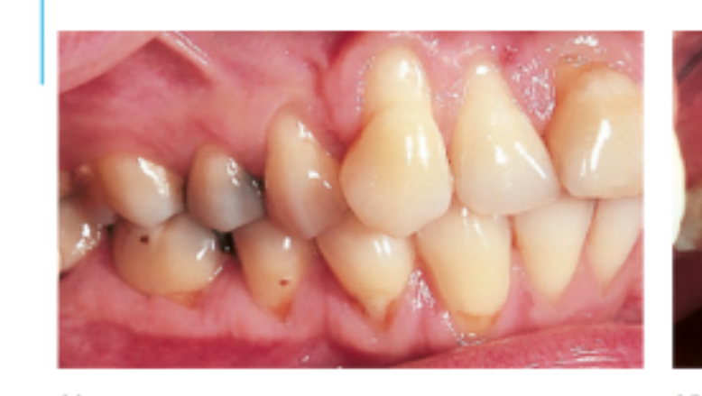 (a) Soft tissue damage as a result of extensive toothbrushing. Note the gingival recession on the buccal gingival surface of tooth 13.