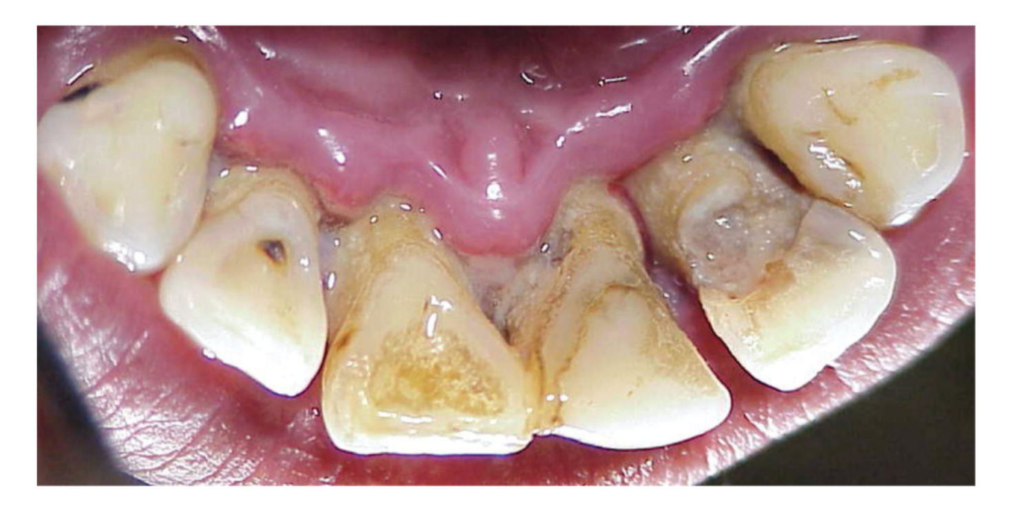 Fig. 19-8 Necrotizing periodontitis: presence of necrosis/ulcer of the interdental papillae. (Source: Courtesy of Dr. Mauro Santamaria.)