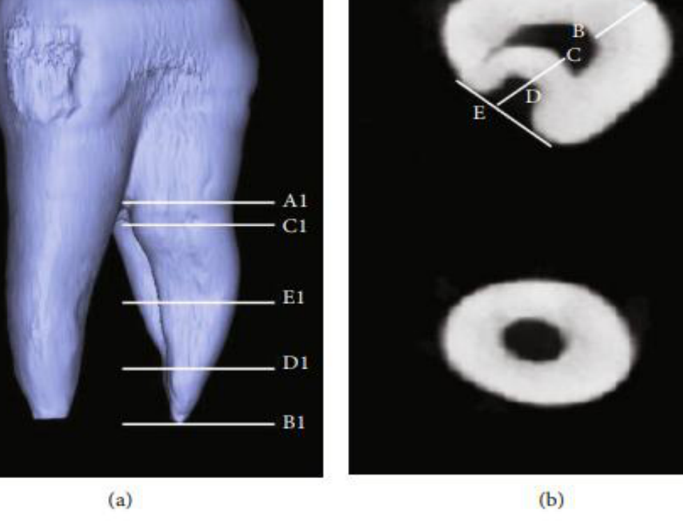 FIGURE 2: Measurement of the buccal root with furcation grooves in maxillary first premolars using micro-CT. (a) Vertical measurement. (b) Horizontal measurement.