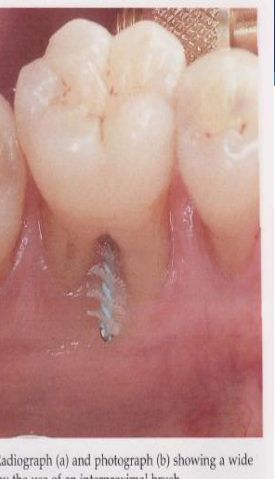 Fig. 39-20 Tunnel preparation of a degree III-involved mandibular molar.