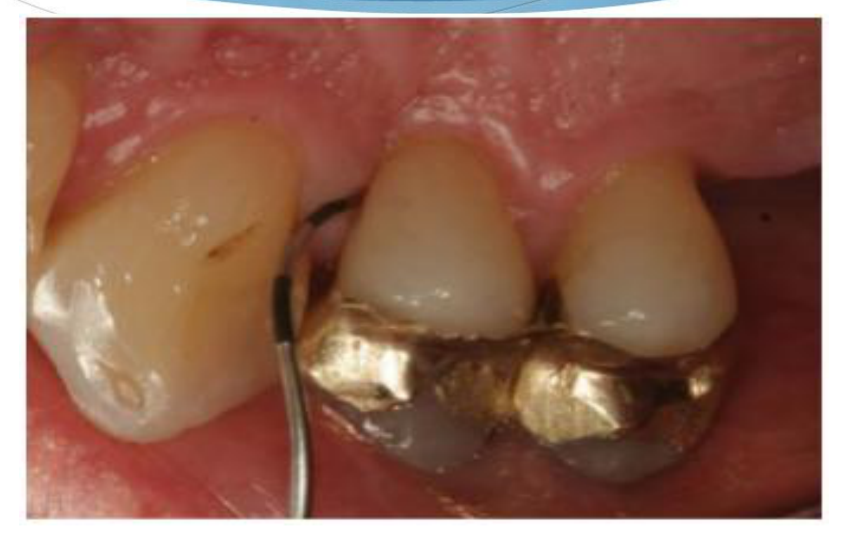Premolar furcation entrance-M and D