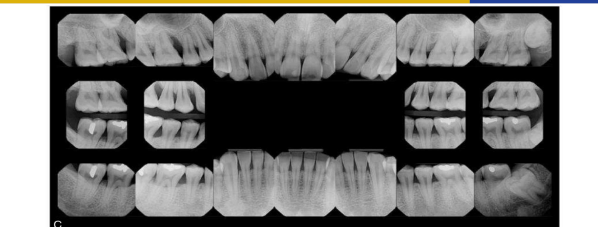 Fig. 41.10 Clinical photos (A and B) and full mouth radiographic series (C) of a patient who had molar-incisor pattern of periodontitis (used to be called “localized aggressive periodontitis”). The overall prognosis is favorable except for the maxillary right first molar (unfavorable), maxillary left first molar (questionable), and mandibular right first molar (questionable).