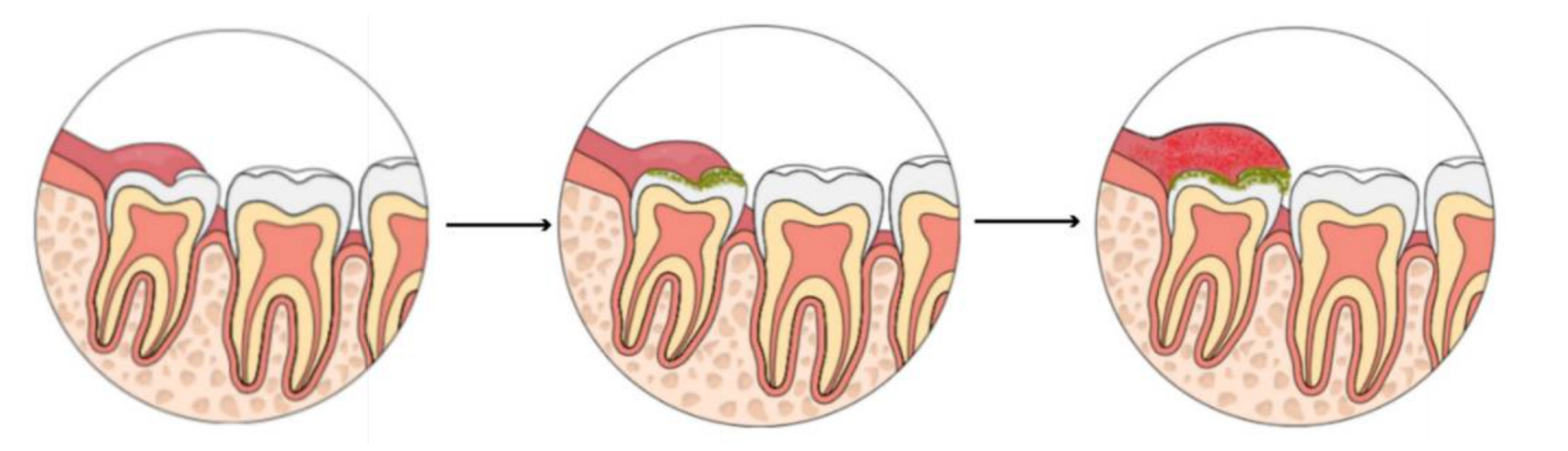 Illustration showing progression of pericoronitis.
