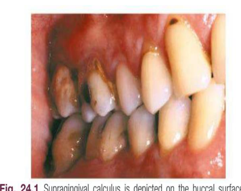 Fig. 24.1 Supragingival calculus is depicted on the buccal surfaces of maxillary molars adjacent to the orifice for the parotid duct.