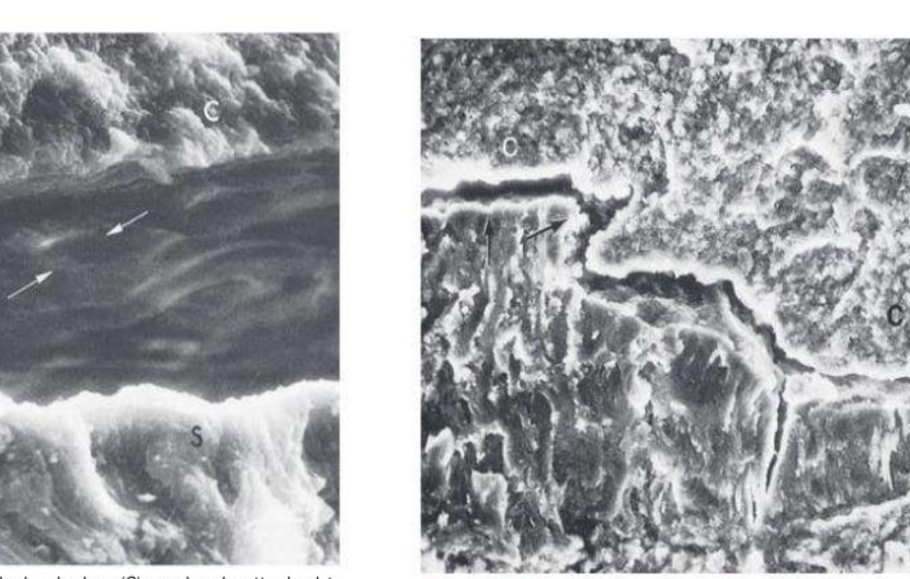 Fig. 24.9 Undersurface of subgingival calculus (C) previously attached to the cementum surface (S). Note the impression of cementum mounds in the calculus (arrows). (Courtesy Dr. John Sottosanti, La Jolla, CA.)