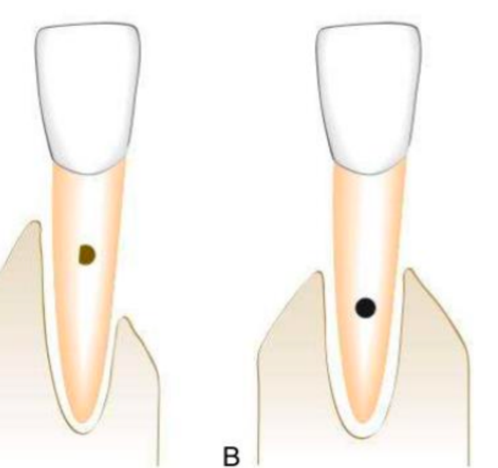 Prognosis of A is better than B Centre of rotation for A is nearer to the crown