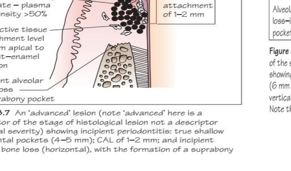 Figure 8.7 An 'advanced' lesion (note 'advanced' here is a descriptor of the stage of histological lesion not a descriptor of clinical severity) showing incipient periodontitis: true shallow periodontal pockets (4–5 mm); CAL of 1–2 mm; and incipient alveolar bone loss (horizontal), with the formation of a suprabony pocket.