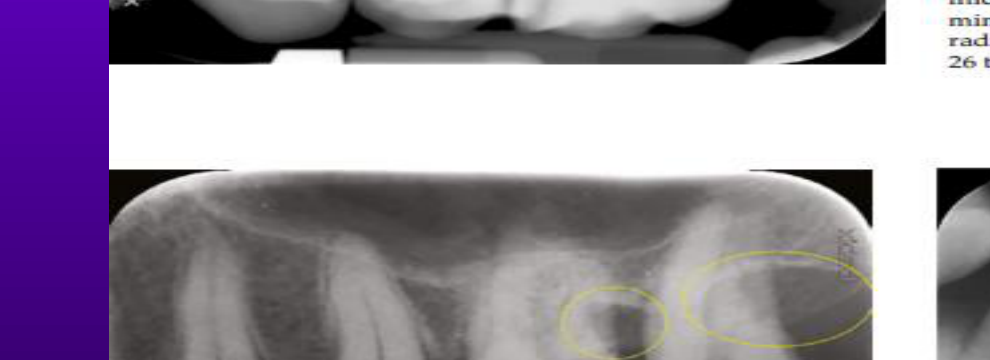 Fig. 23-19 A periapical image demonstrating a radiolucent triangle superimposed over the distal roots of tooth 26 and demonstrating the hooks of the "J" shaped radiolucency on the distal root of tooth 27, both of which indicate bone destruction extending into the furcation of the respective regions (yellow circles).