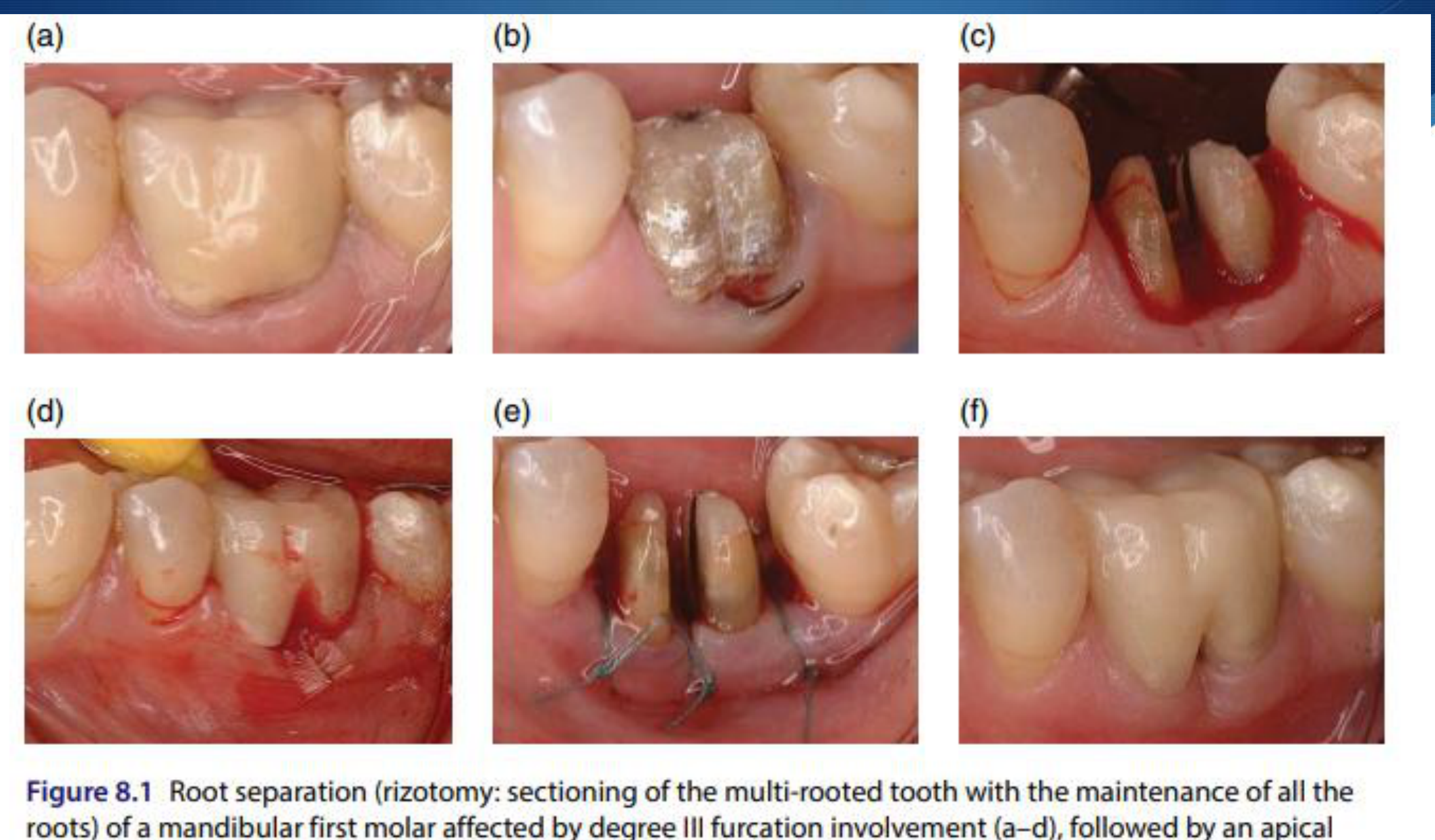 Figure 8.1 Root separation (rizotomy: sectioning of the multi-rooted tooth with the maintenance of all the roots) of a mandibular first molar affected by degree III furcation involvement (a–d), followed by an apical positioned flap (e) and final restoration (f), allowing self-performed oral hygiene.