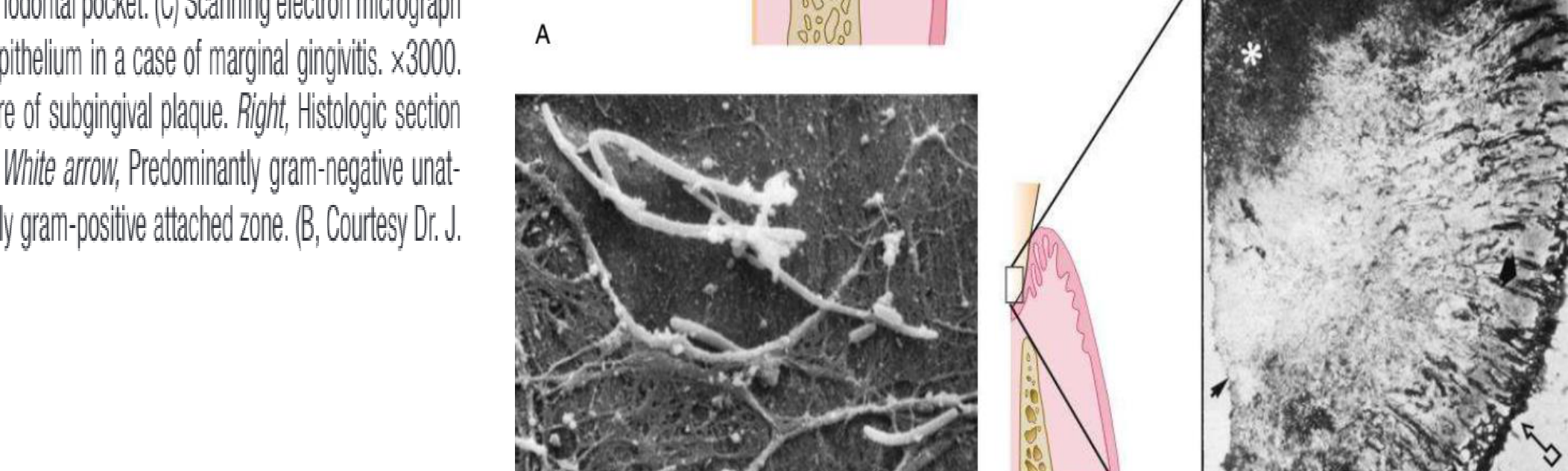 (D) Left, Diagrammatic representation of the histologic structure of subgingival plaque. Right, Histologic section of subgingival plaque. Arrow with box, Sulcular epithelium. White arrow, Predominantly gram-negative unattached zone. Black arrow, Tooth surface. Asterisk, Predominantly gram-positive attached zone.