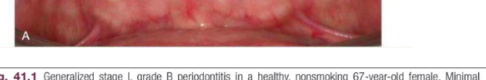 Fig. 41.1 Generalized stage I, grade B periodontitis in a healthy, nonsmoking 67-year-old female. Minimal clinical biofilm and gingival inflammation (A and B) and radiographic bone loss (C). Overall prognosis is favorable. (Copyright Jonathan H. Do, DDS. All rights reserved.)