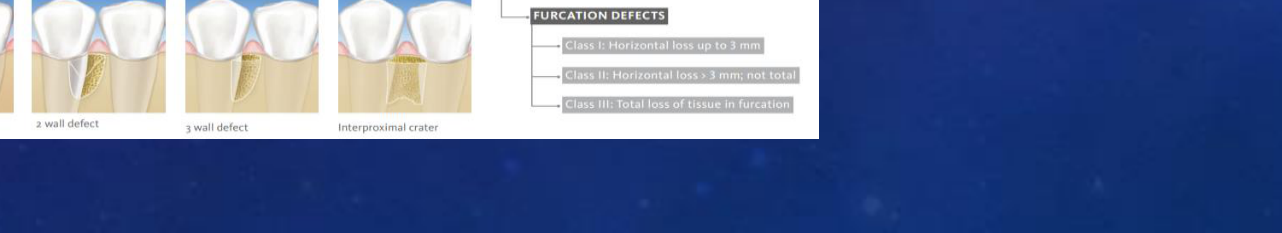 FIG. 4: Intrabony defects (modified from Papapanou et al. 2009)