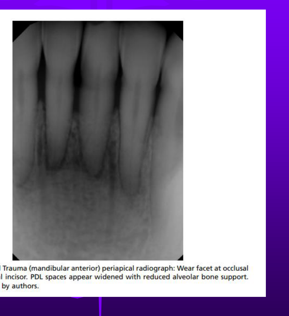 Fig. 17. Occlusal Trauma (mandibular anterior) periapical radiograph: Wear facet at occlusal aspect of central incisor. PDL spaces appear widened with reduced alveolar bone support. Image provided by authors.