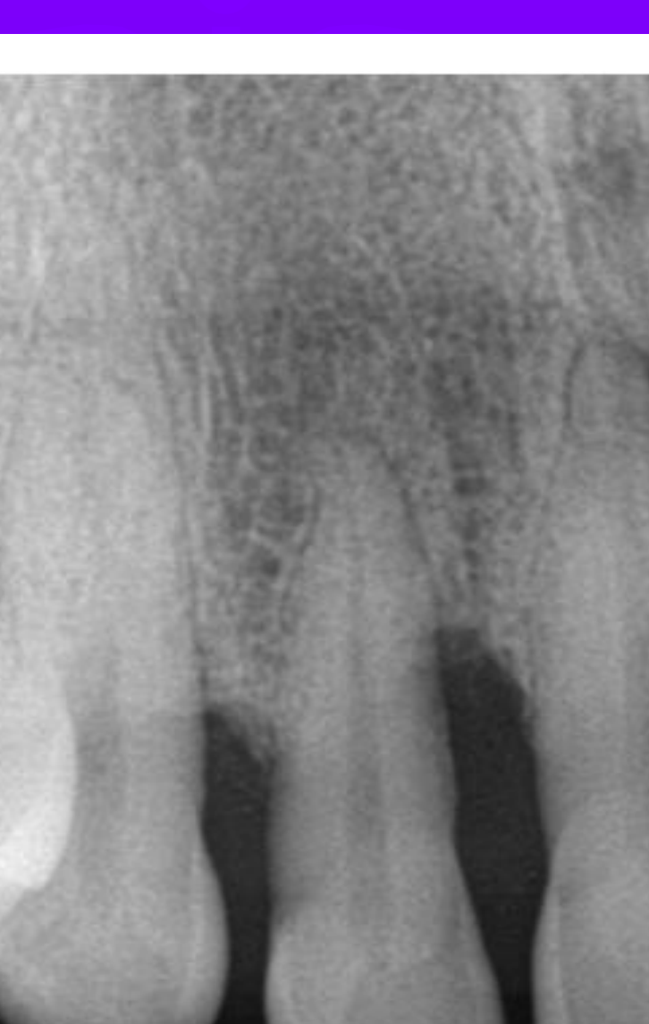 Fig. 7. Periodontal Disease (maxillary right anterior) periapical radiograph: Alveolar crest levels appear indistinct, with vertical (angular) bone loss that is not parallel to the CEJs of adjacent teeth. Image provided by authors.
