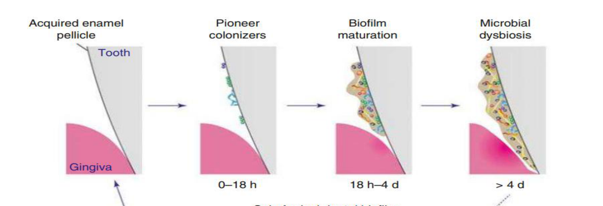 Fig. 10.7 Accumulation of dental biofilm and progression to disease.