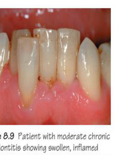 Figure 8.9 Patient with moderate chronic periodontitis showing swollen, inflamed gingivae and recession/clinical attachment loss. The gingival margins are blunted and there is loss of contour.