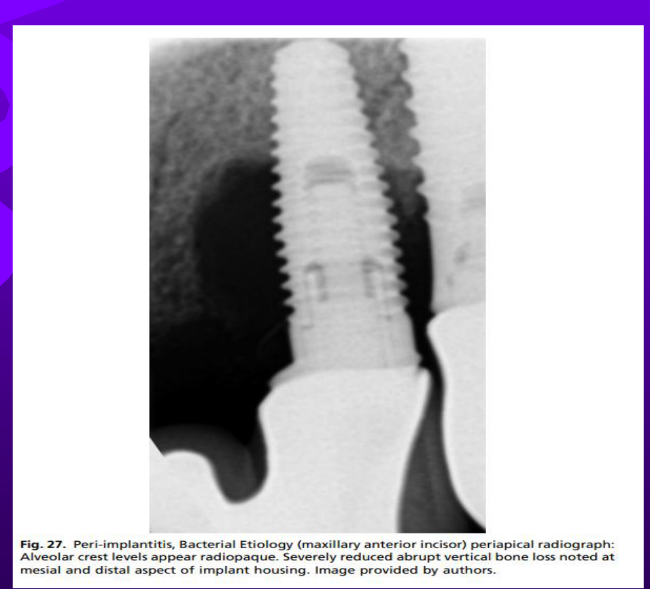 Fig. 27. Peri-implantitis, Bacterial Etiology (maxillary anterior incisor) periapical radiograph: Alveolar crest levels appear radiopaque. Severely reduced abrupt vertical bone loss noted at mesial and distal aspect of implant housing. Image provided by authors.