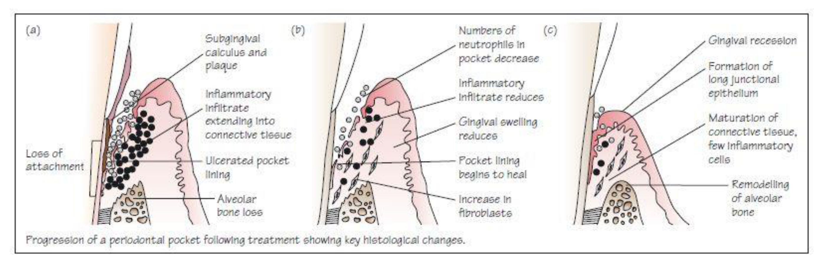 Progression of a periodontal pocket following treatment showing key histological changes.