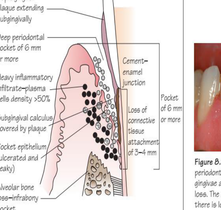 Figure 8.8 An 'advanced' lesion (note 'advanced' here is a descriptor of the stage of histological lesion not a descriptor of clinical severity) showing moderate periodontitis: typically, true deep periodontal pockets (6 mm or more) and CAL of 3–4 mm are present; alveolar bone loss may be vertical, rather than horizontal, with the formation of an infrabony pocket. Note that 5 mm or more of CAL is considered to be severe.