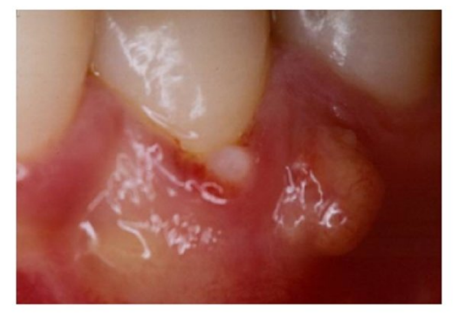 Gingival abscess