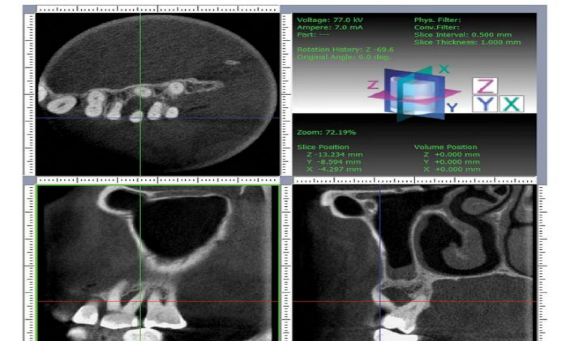 Figure 2.8 Diagnosis and treatment planning using cone-beam computed tomography (CBCT). CBCT images with horizontal, sagittal, and transversal sections of first and second left maxillary molars. According to the bone loss around the disto-buccal root and the remaining periodontal attachment around the mesio-buccal and palatal root, it was decided to extract the distobuccal root. Source: Walter et al. (2010).