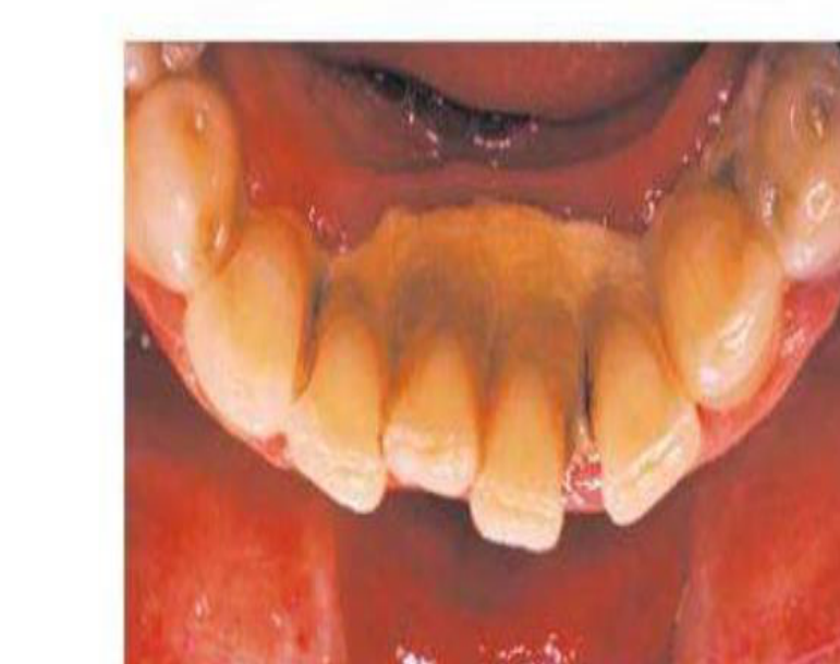 Fig. 24.2 Extensive supragingival calculus is present on the lingual surfaces of the lower anterior teeth.