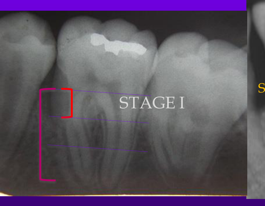 STAGE I
