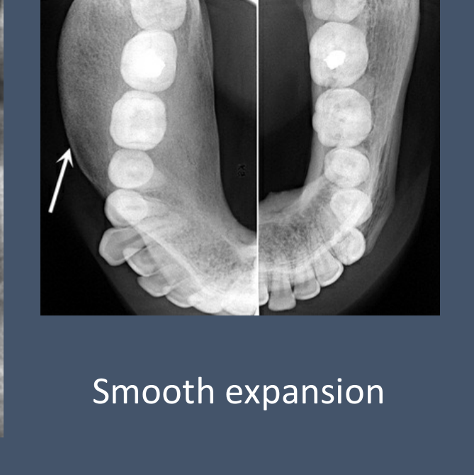Smooth expansion