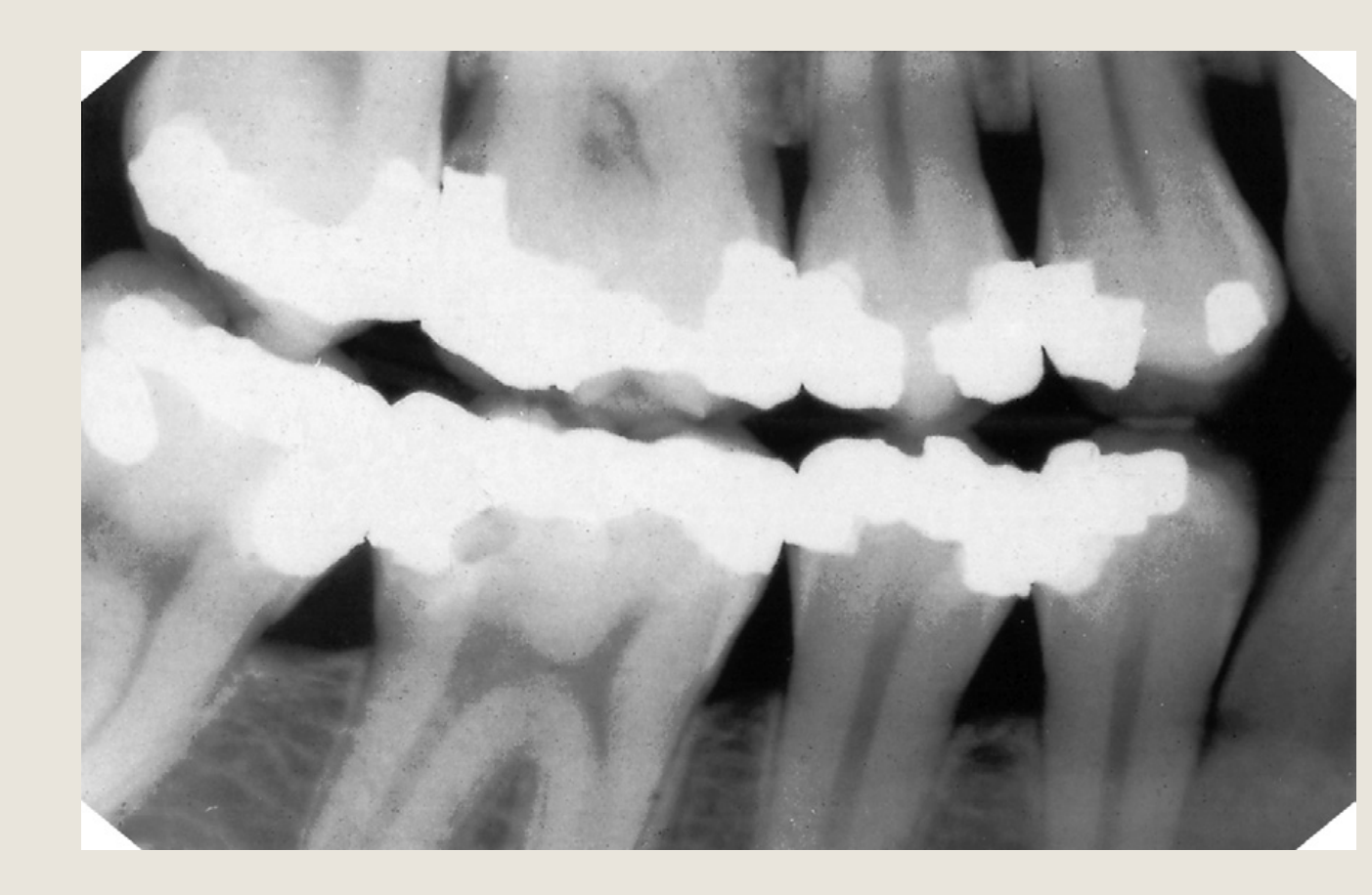 Right Posterior Bitewing Radiograph