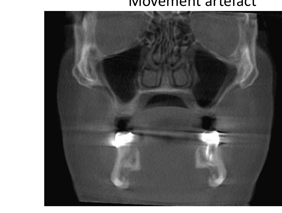 Movement artefact
