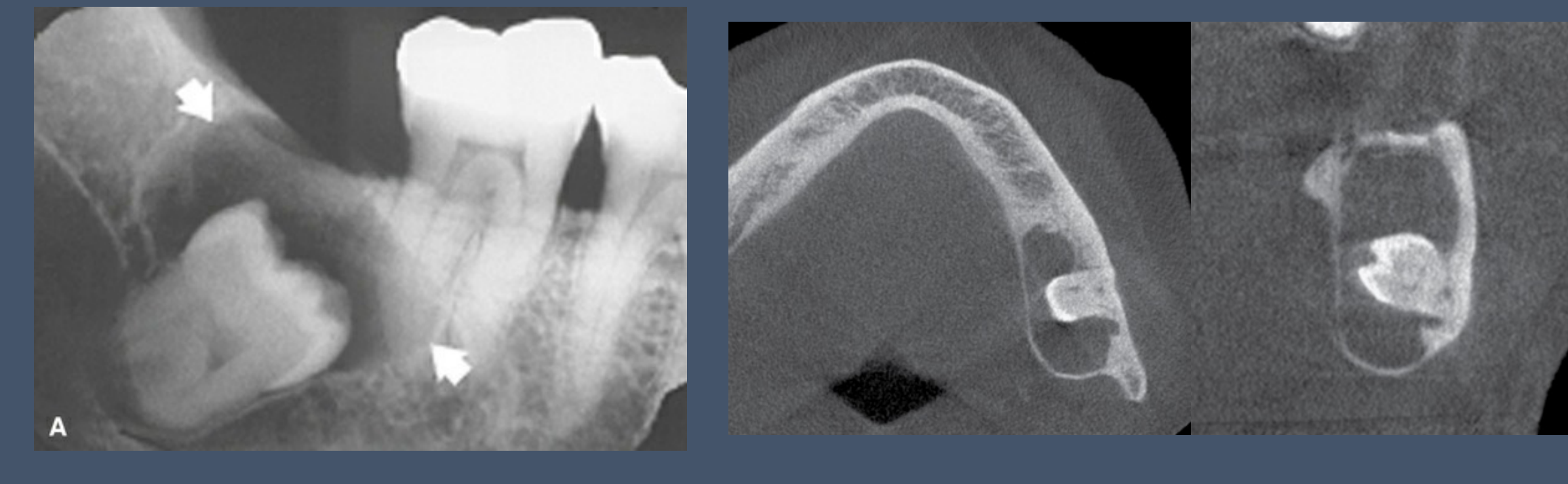 Dentigerous cysts have a pericoronal relationship with unerupted teeth ie. associated with crown
