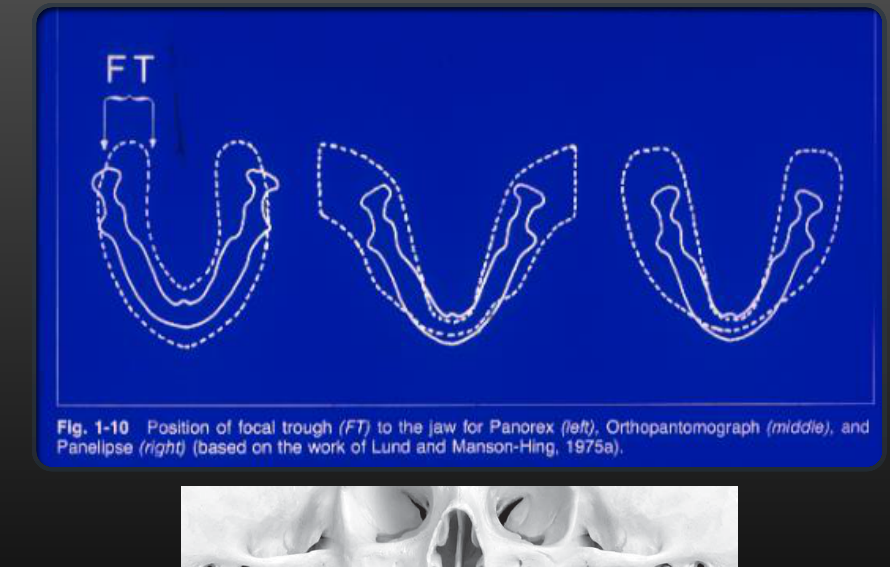 Fig. 1-10 Position of focal trough (FT) to the jaw for Panorex (left), Orthopantomograph (middle), and Panelipse (right) (based on the work of Lund and Manson-Hing, 1975a).