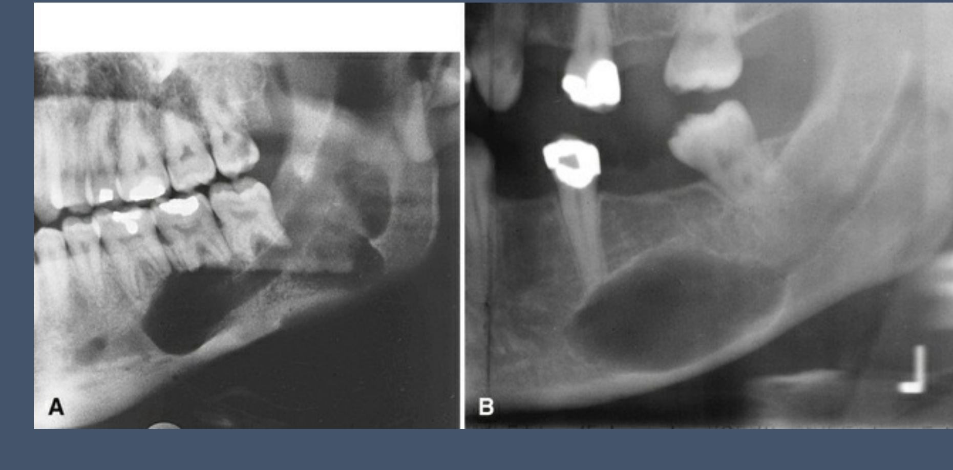 Fusiform, expansile lucency associated with mandibular canal Neurofibroma (strong association with Neurofibromatosis type 1 (NF1)