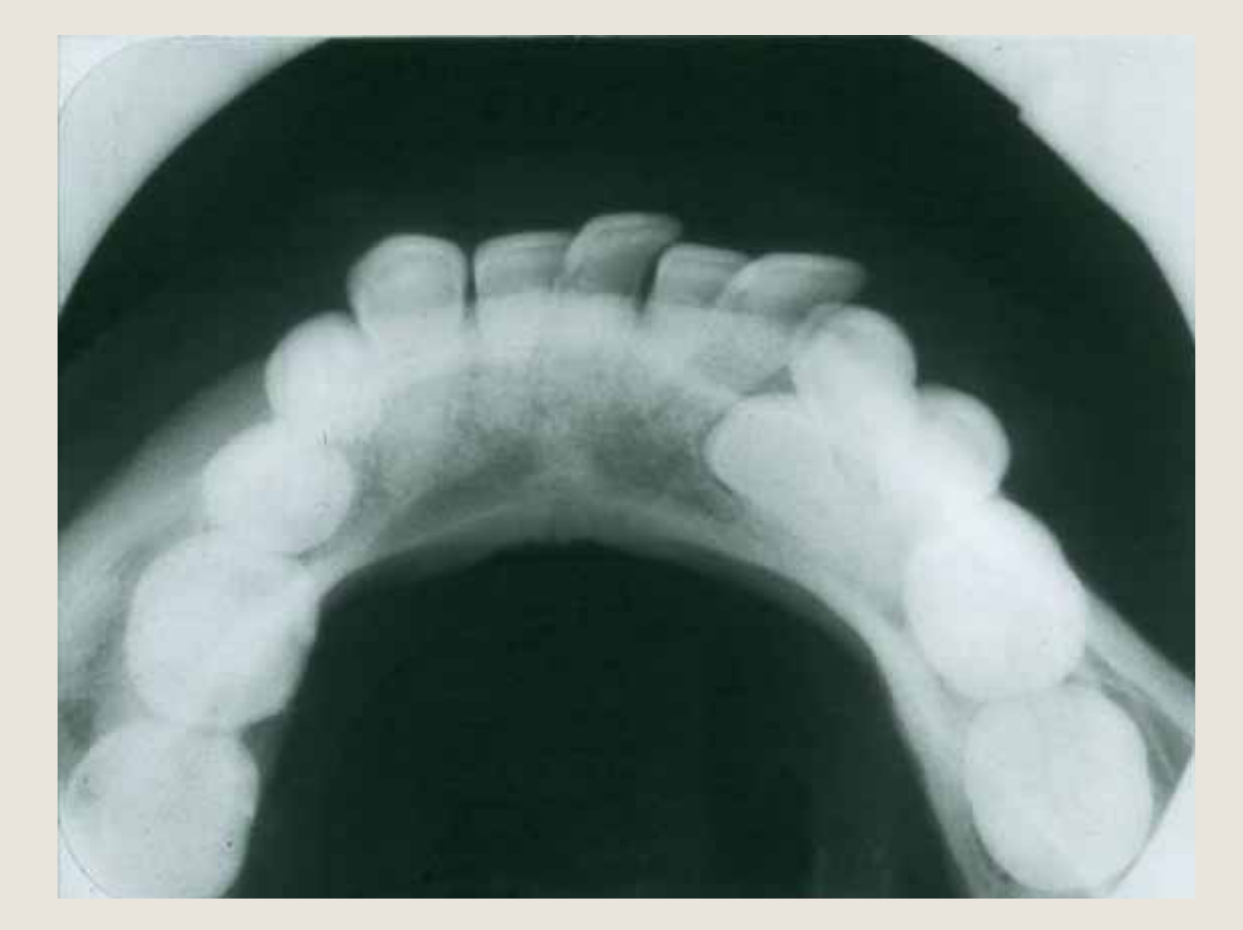 No SLOB rule – Occlusograph shows the B/L position
