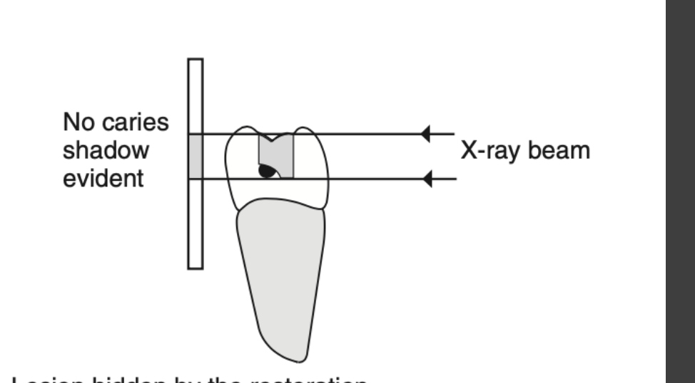 A (ii) Lesion hidden by the restoration
