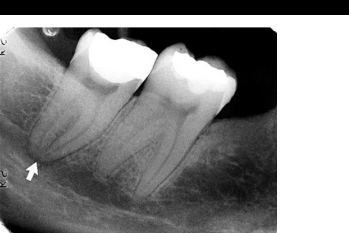 FIG. 12.58 Superimposition of the inferior alveolar canal over the apex of a molar causes the image of the periodontal ligament space to appear wider (arrow). However, the presence of an intact lamina dura indicates that there is no periapical disease.