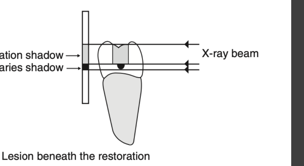A (i) Lesion beneath the restoration