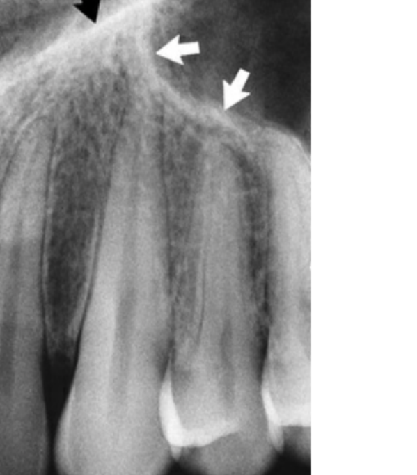 FIG. 12.37 The anterior border of the maxillary sinus (white arrows) crosses the floor of the nasal fossa (black arrow).