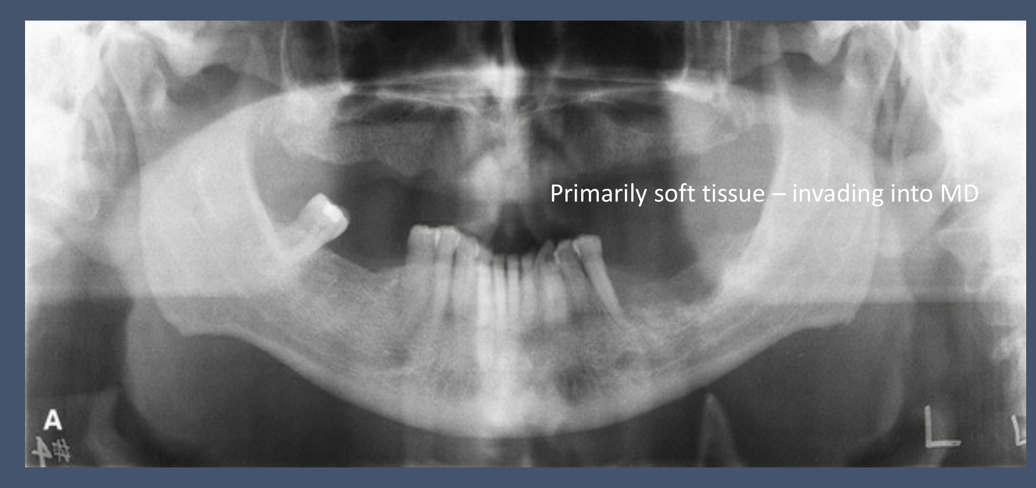 Squamous cell carcinoma (oral cavity)