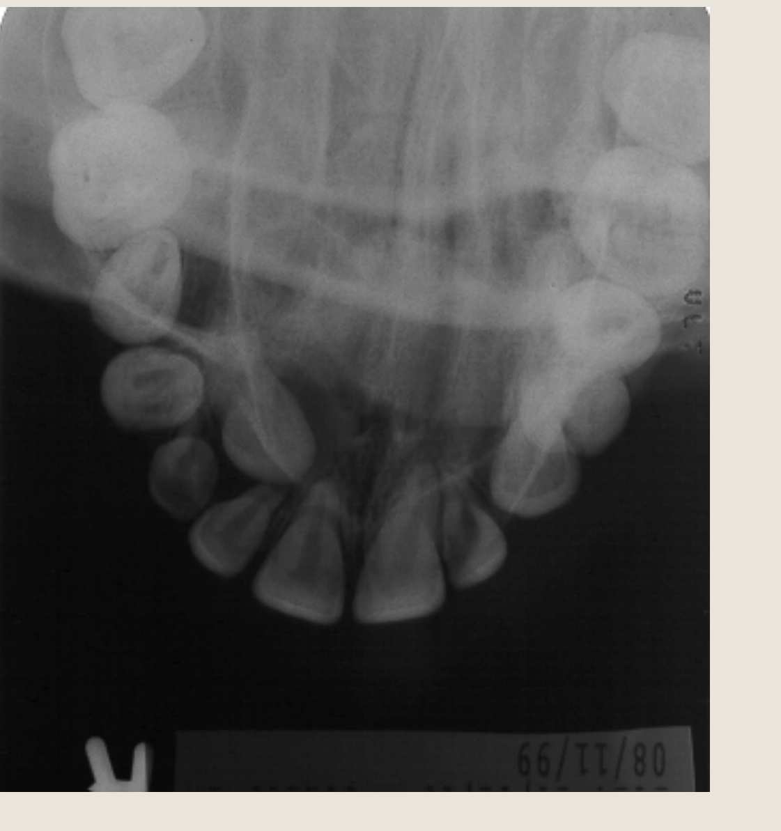 Maxilla