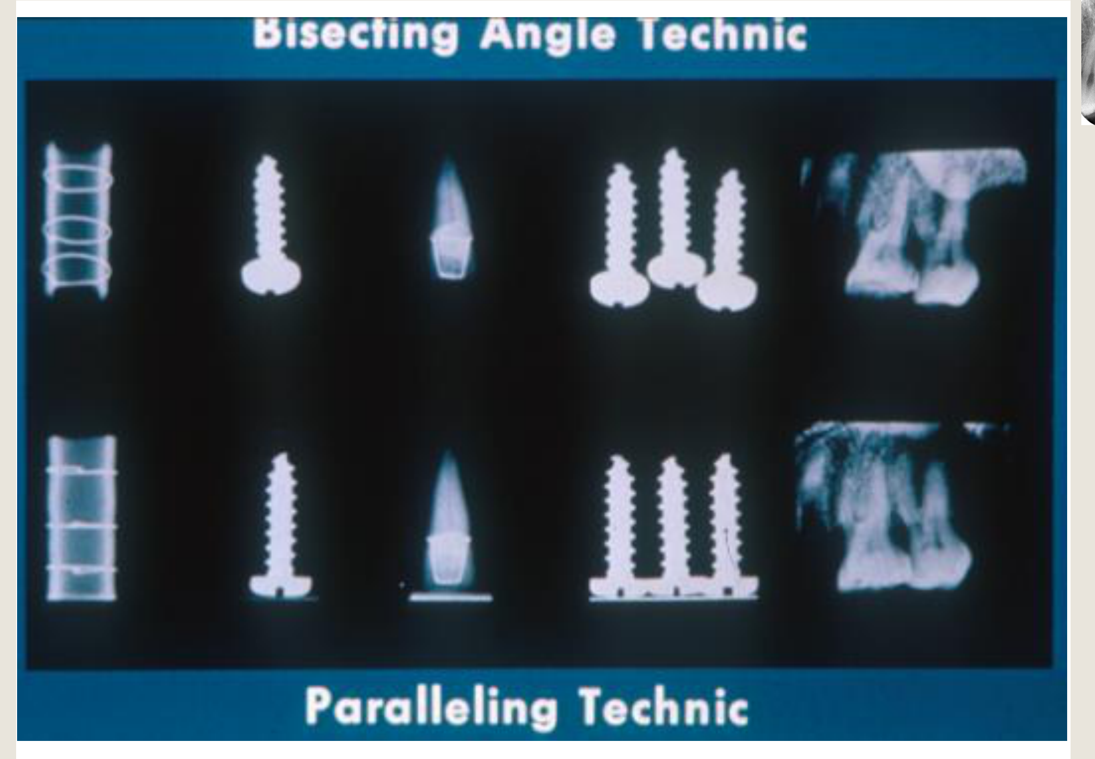 Bisecting Angle Technic / Paralleling Technic