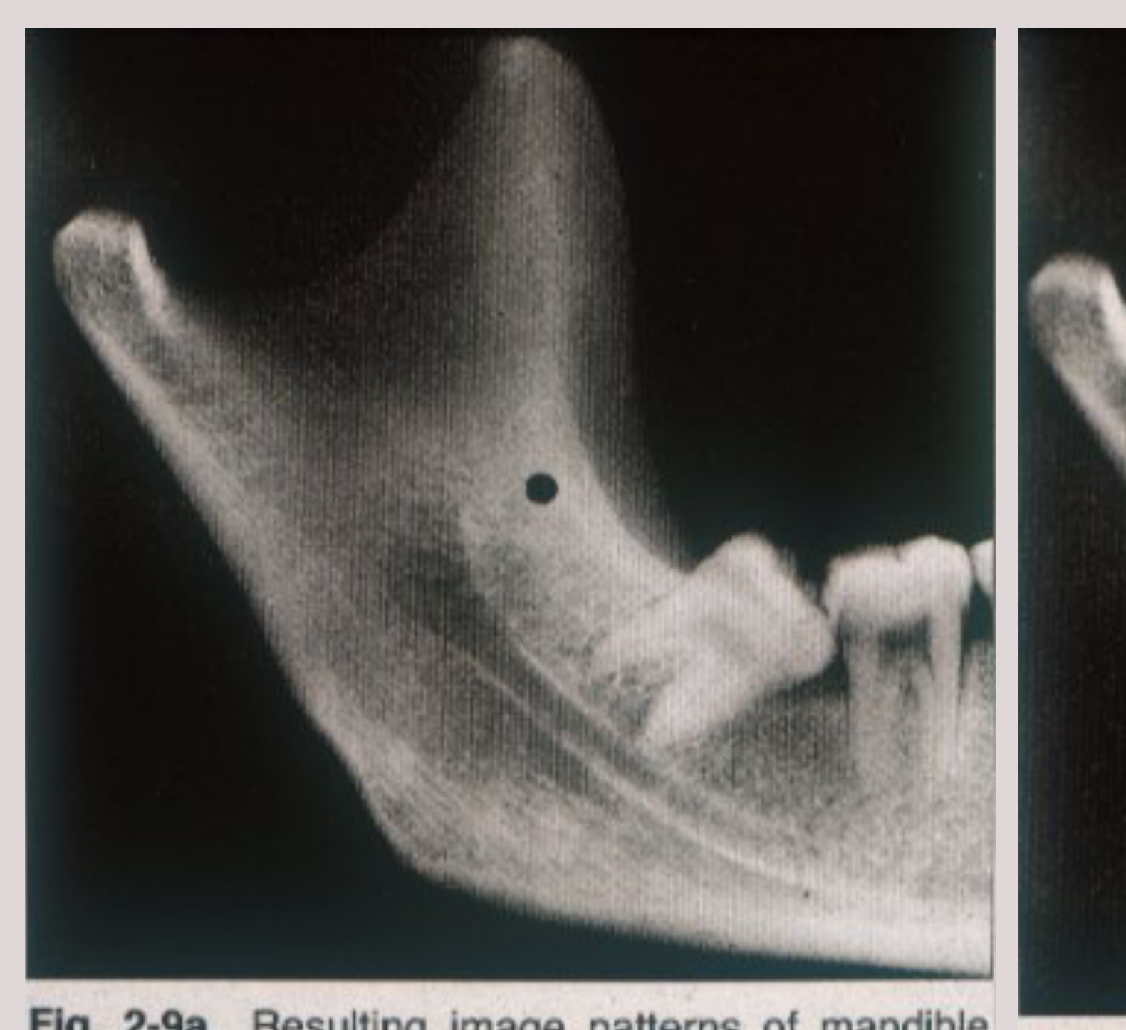 Fig. 2-9a Resulting image patterns of mandible exposed on film directly.